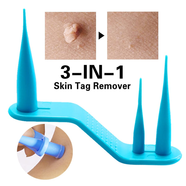 Skin Tag Removal Kit Mole Wart